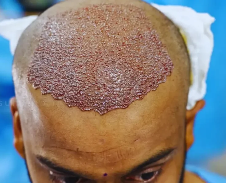 Hair-Follicle-Surgery-A-Complete-Guide-to-Hair-Restoration